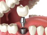 ایمپلنت دندان چیست + مزایا و معایب آن