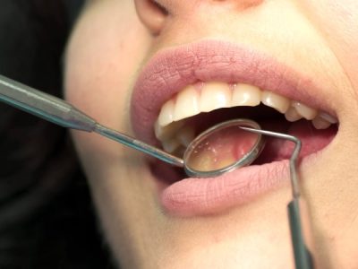چه موقعی باید دندان عقل را بکشیم؟