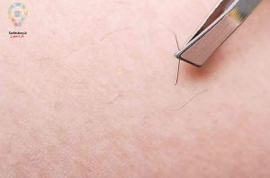 دلیل موهای زیر پوستی چیست ؟ | پیشگیری از موهای زیر پوستی