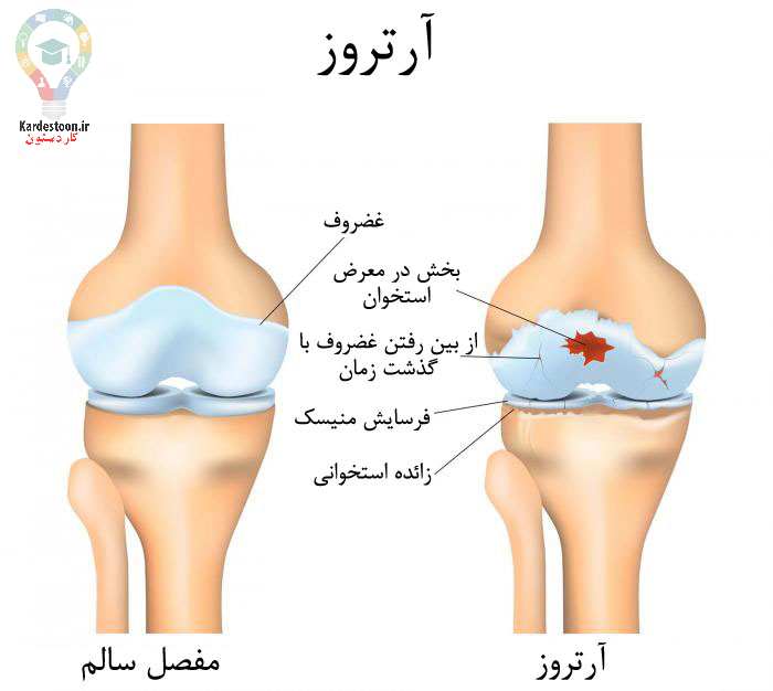علل و علائم قفل شدن زانو در خواب + راه درمان