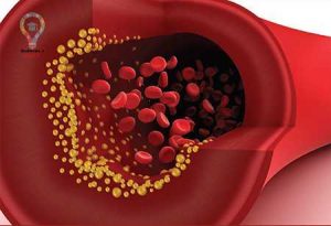 علائم چربی خون