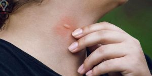 چند راه موثر برای جلوگیری از نیش حشرات