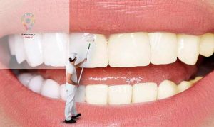 چگونه از زرد شدن کامپوزیت دندان جلوگیری کنیم؟