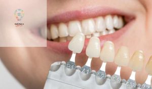 چگونه از زرد شدن کامپوزیت دندان جلوگیری کنیم؟